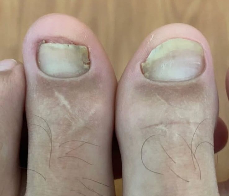 Micose antes do tratamento