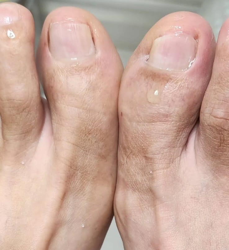 Micose após tratamento