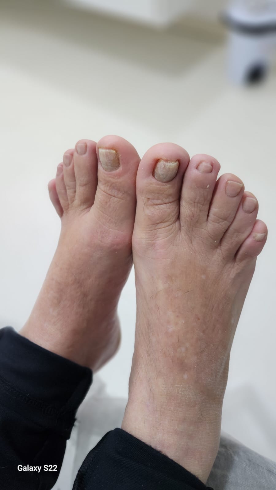 Unha após correção com órtese