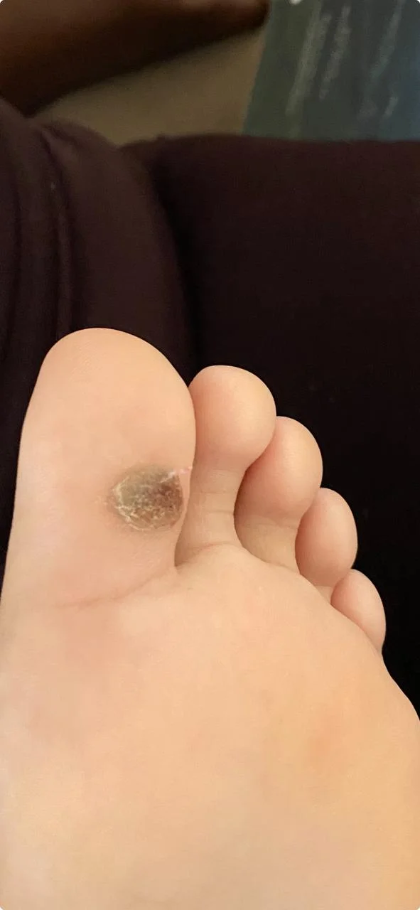 Verruga plantar antes do tratamento